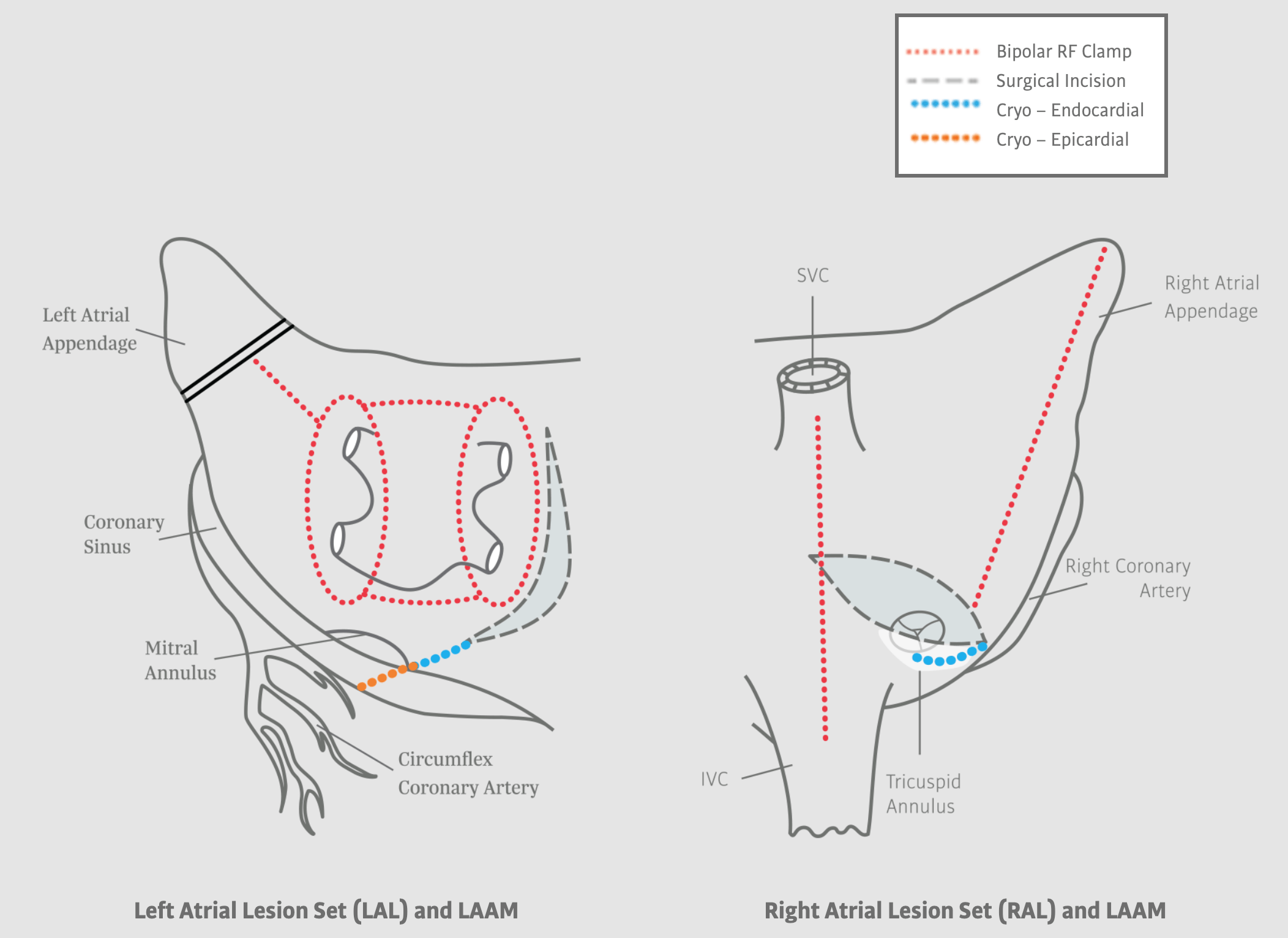 Left Atrial Lesion Set for Surgical Ablation