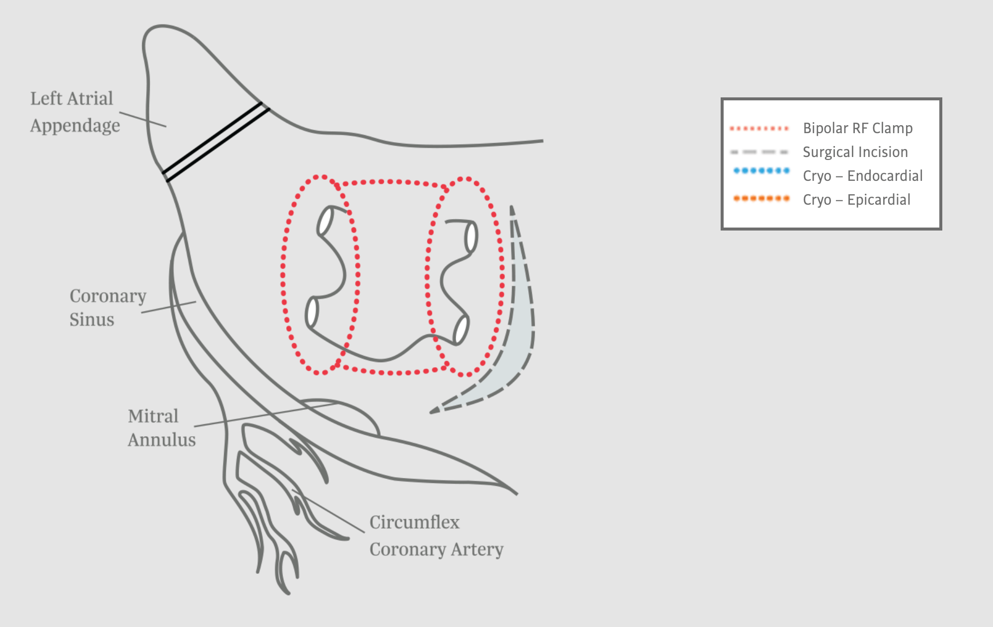 Box Lesion Set for Surgical Ablation