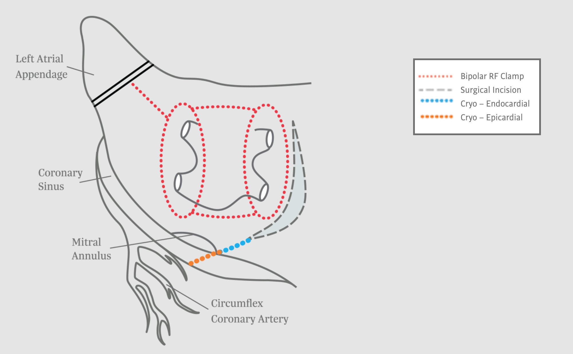 Left Atrial Lesion Set for Surgical Ablation