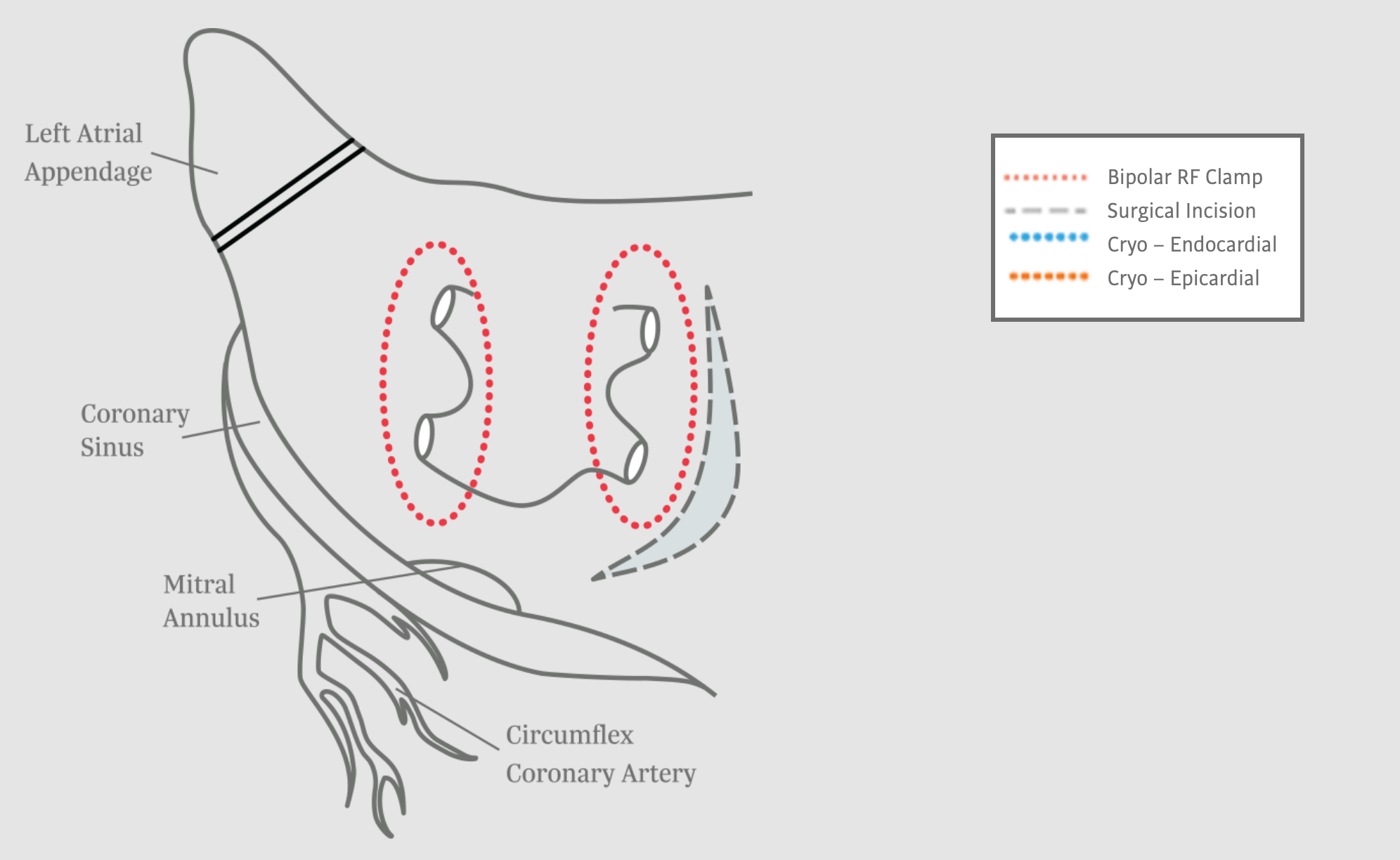 Pulmonary Vein Isolation for Surgical Ablation